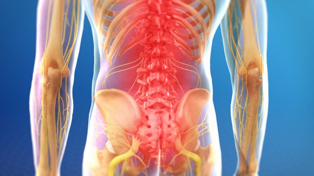 Intracept Procedure For Chronic Lower Back Pain DISC