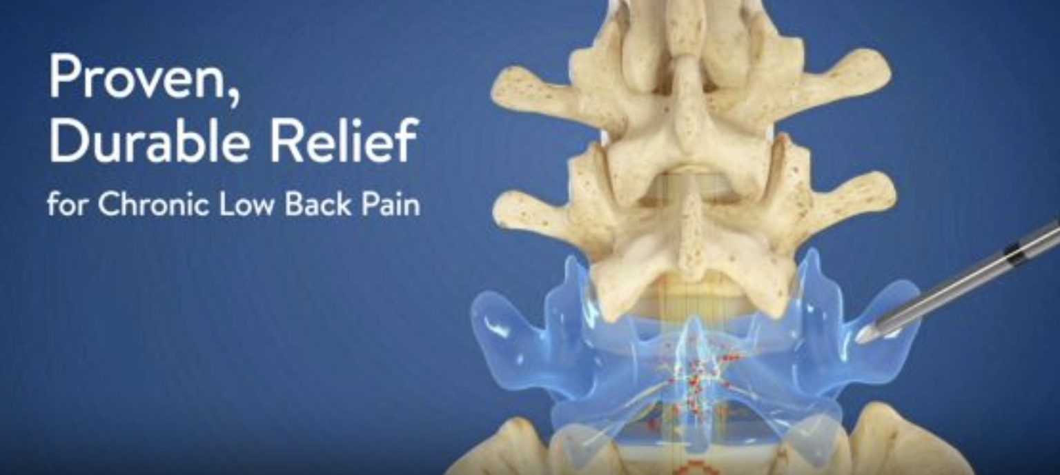 Intracept Procedure For Chronic Lower Back Pain DISC