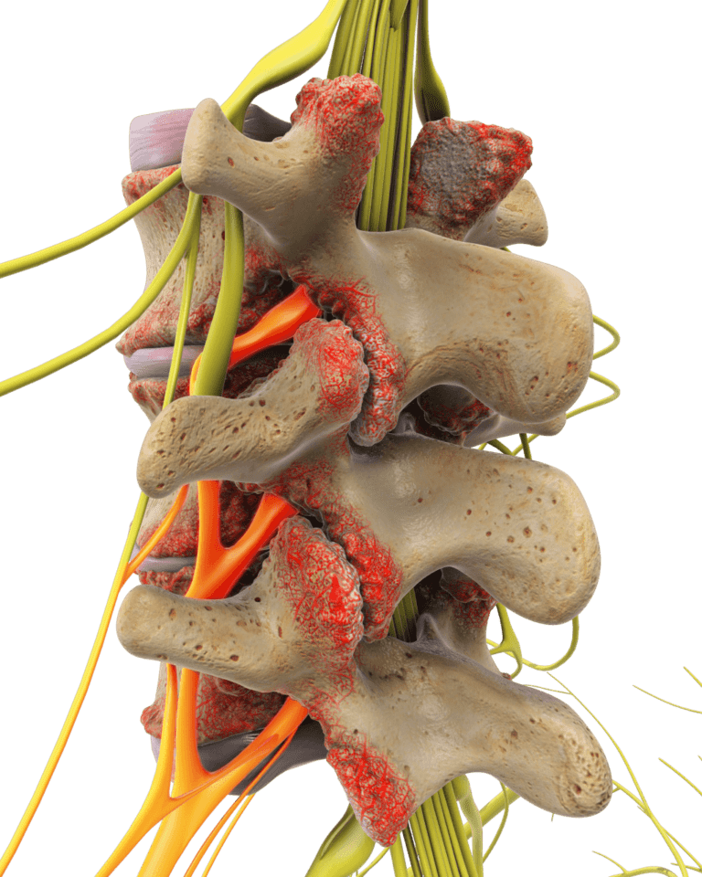 Diagnosis And Treatment Of Spinal Bone Spurs In Az Disc 8732