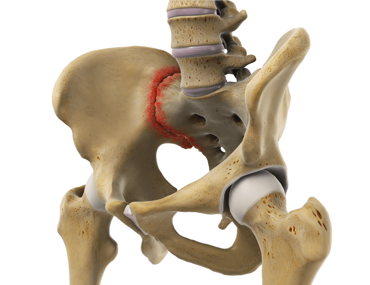 Model of a hip with sacroiliac joint dysfunction