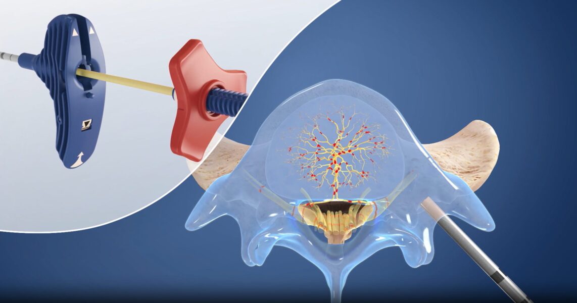 Intracept® Procedure For Chronic Lower Back Pain | DISC