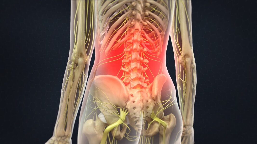 Intracept® Procedure For Chronic Lower Back Pain | DISC