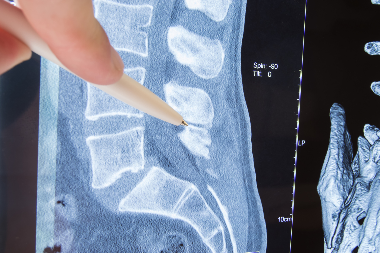 Radiologist indicated on possible pathology or disease of image of spine lumbosacral MRI such as sciatica, protrusion of disc, pinched nerve, hernia, stenosis