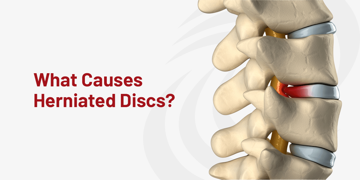 https://www.sciatica.com/wp-content/uploads/2024/02/01-What-Causes-Herniated-Discs.png